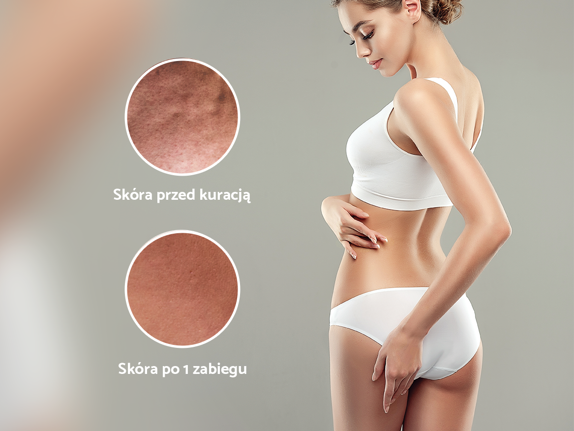 Rzeźbienie sylwetki z efektem ,,lipolysis-like’’
