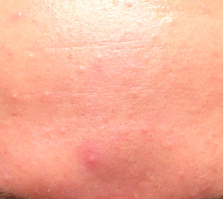 Acne Out Therapy
