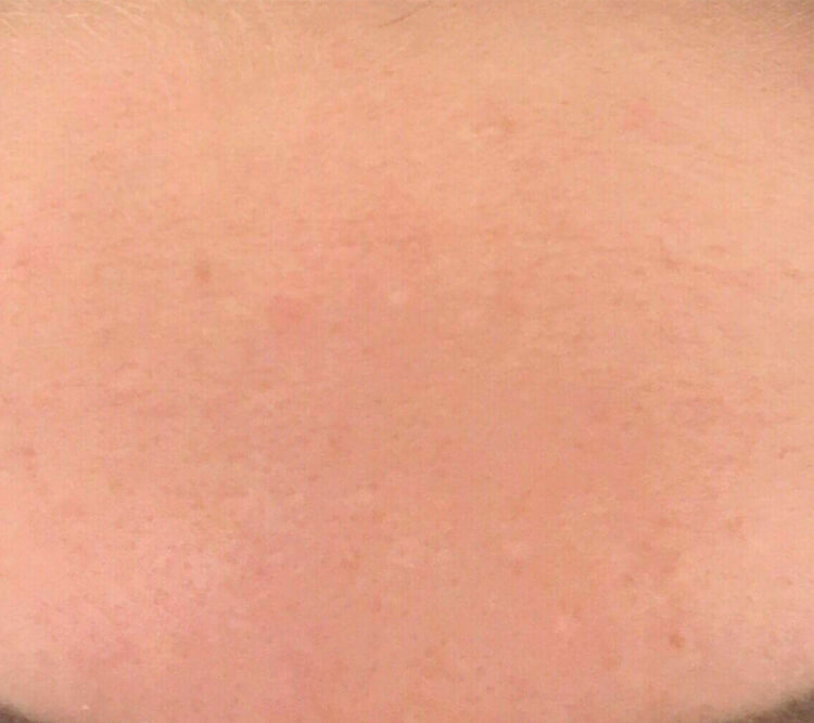 Acne Out Therapy