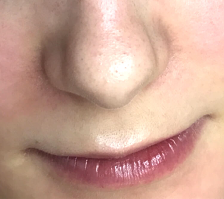 Lactobionic Therapy