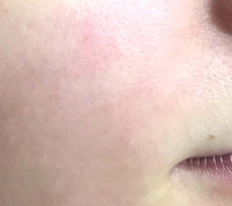 Lactobionic Therapy