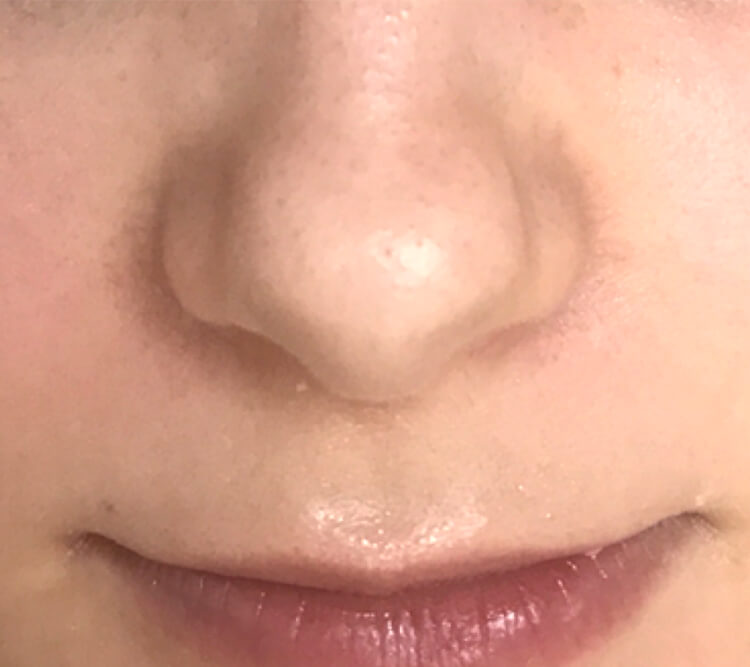 Lactobionic Therapy